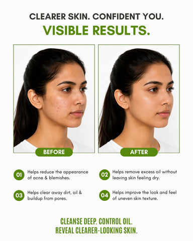 Veloni Anti Acne Cleanser | Salicylic Acid & Niacinamide Face Cleanser